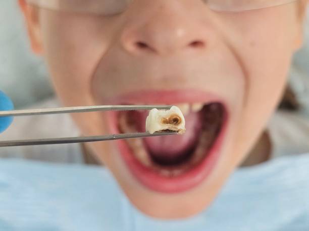 Best Emergency Tooth Extraction in Lton, IN